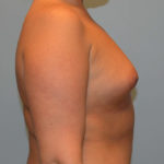 Breast Augmentation Before & After Patient #2912