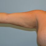 Arm Lift (Scarless Arm Lift) Before & After Patient #2890