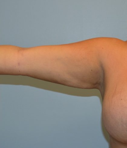 Arm Lift (Scarless Arm Lift) Before & After Patient #2890