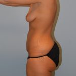 Tummy Tuck Before & After Patient #2984