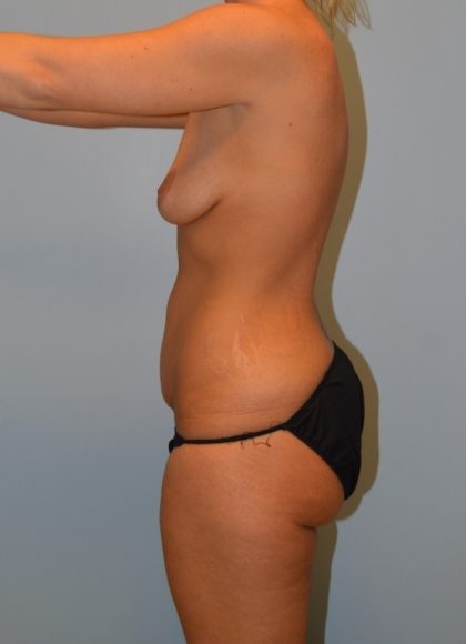 Tummy Tuck Before & After Patient #2984