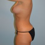 Tummy Tuck Before & After Patient #2984