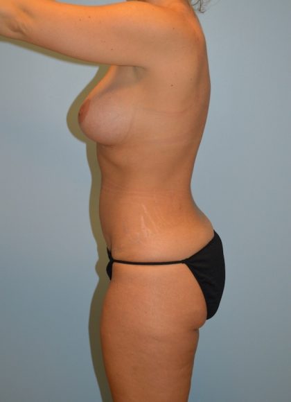 Tummy Tuck Before & After Patient #2984