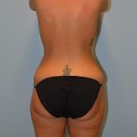 Tummy Tuck Before & After Patient #2984