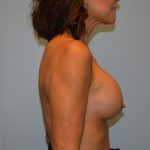 Breast Augmentation Before & After Patient #2819