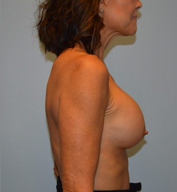 Breast Augmentation Before & After Patient #2819