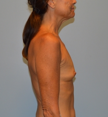 Breast Augmentation Before & After Patient #2819