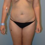 Tummy Tuck Before & After Patient #2958