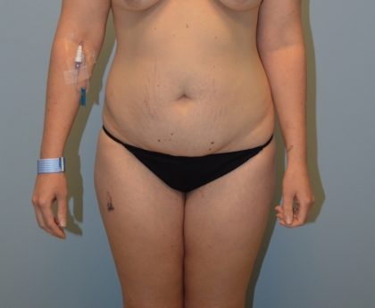 Tummy Tuck Before & After Patient #2958