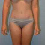 Tummy Tuck Before & After Patient #2958