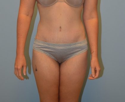 Tummy Tuck Before & After Patient #2958