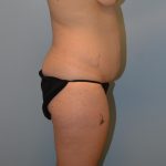 Tummy Tuck Before & After Patient #2958