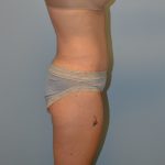 Tummy Tuck Before & After Patient #2958