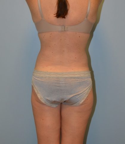 Tummy Tuck Before & After Patient #2958