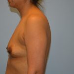 Breast Augmentation Before & After Patient #2834