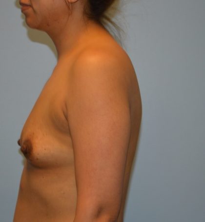Breast Augmentation Before & After Patient #2834