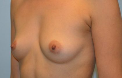 Breast Augmentation Before & After Patient #2841