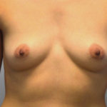 Breast Augmentation Before & After Patient #2841