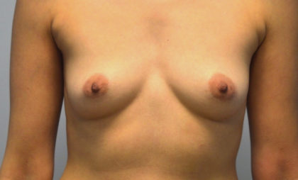 Breast Augmentation Before & After Patient #2841
