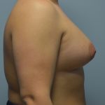 Breast Augmentation Before & After Patient #2848