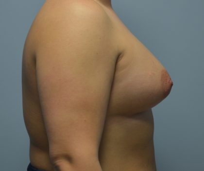 Breast Augmentation Before & After Patient #2848