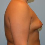 Breast Augmentation Before & After Patient #2848