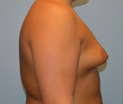 Breast Augmentation Before & After Patient #2848