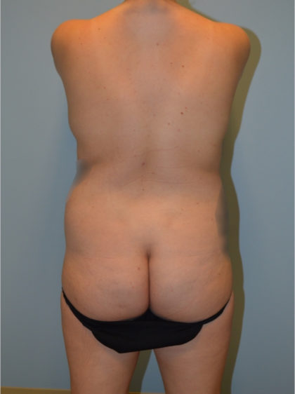 Brazilian Butt Lift Before & After Patient #2891