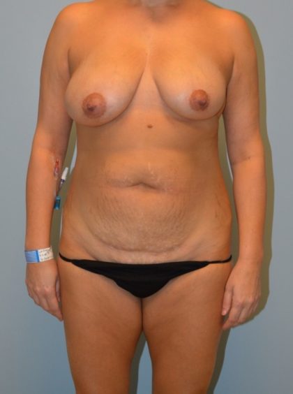 Tummy Tuck Before & After Patient #2985