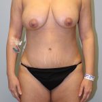 Tummy Tuck Before & After Patient #2985