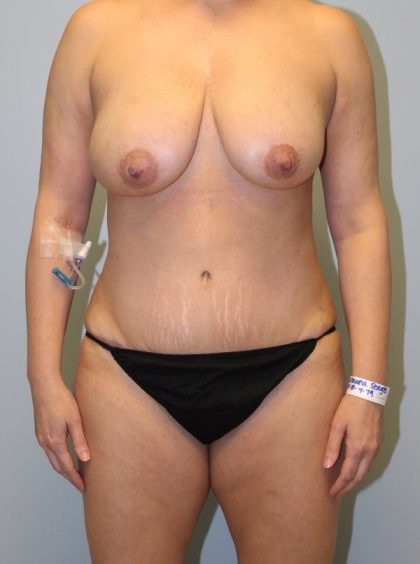 Tummy Tuck Before & After Patient #2985