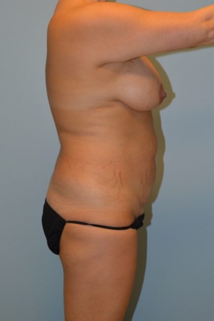 Tummy Tuck Before & After Patient #2985