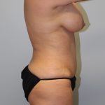 Tummy Tuck Before & After Patient #2985