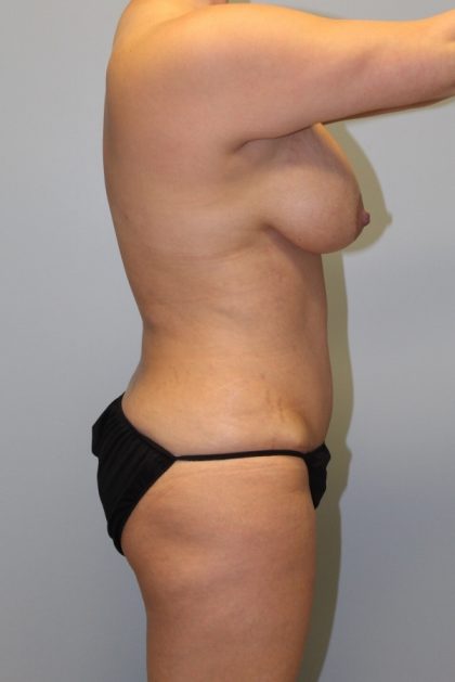 Tummy Tuck Before & After Patient #2985