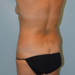 Tummy Tuck Before & After Patient #2985