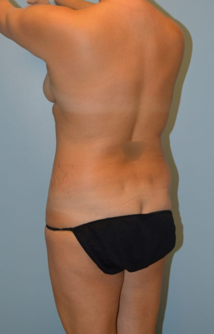 Brazilian Butt Lift Before & After Patient #3669
