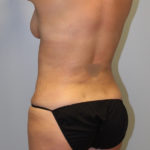 Tummy Tuck Before & After Patient #2985