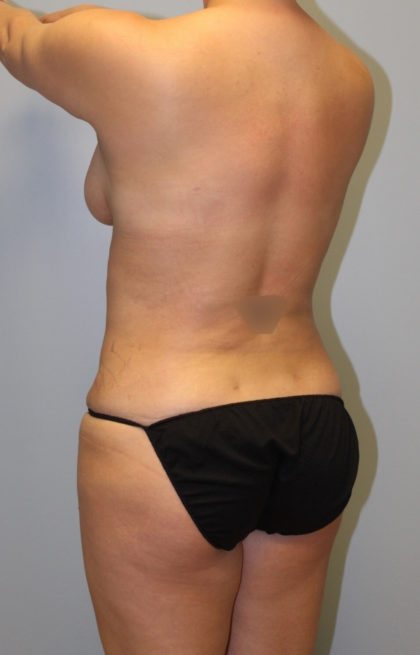 Brazilian Butt Lift Before & After Patient #3669