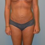 Liposuction Before & After Patient #2855