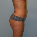 Liposuction Before & After Patient #2855