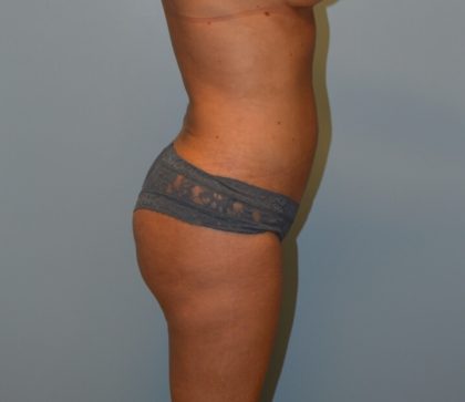 Liposuction Before & After Patient #2855