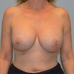 Corrective Breast Procedures Before & After Patient #2863