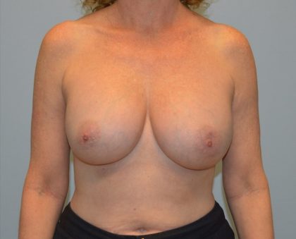 Corrective Breast Procedures Before & After Patient #2863