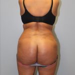 Brazilian Butt Lift Before & After Patient #3649