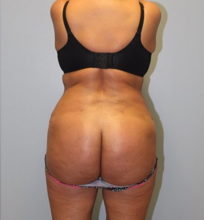 Brazilian Butt Lift Before & After Patient #3649