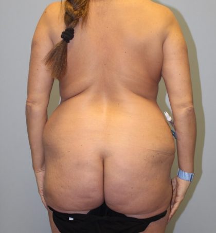 Brazilian Butt Lift Before & After Patient #3649