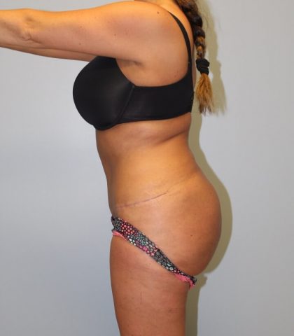 Liposuction Before & After Patient #2866