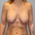 Corrective Breast Procedures Before & After Patient #2936