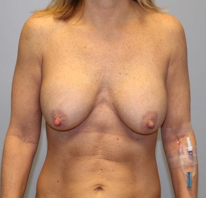 Corrective Breast Procedures Before & After Patient #2936