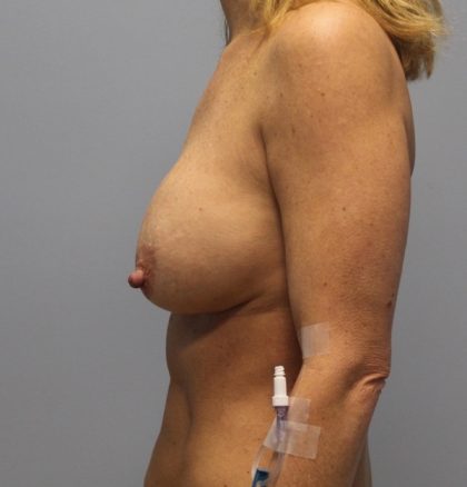 Corrective Breast Procedures Before & After Patient #2936
